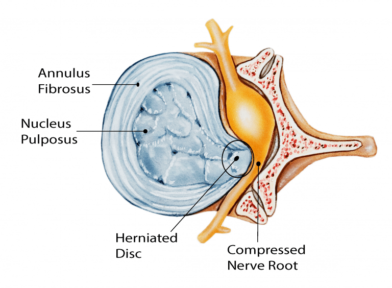 lumbar disc herniation, slipped disc