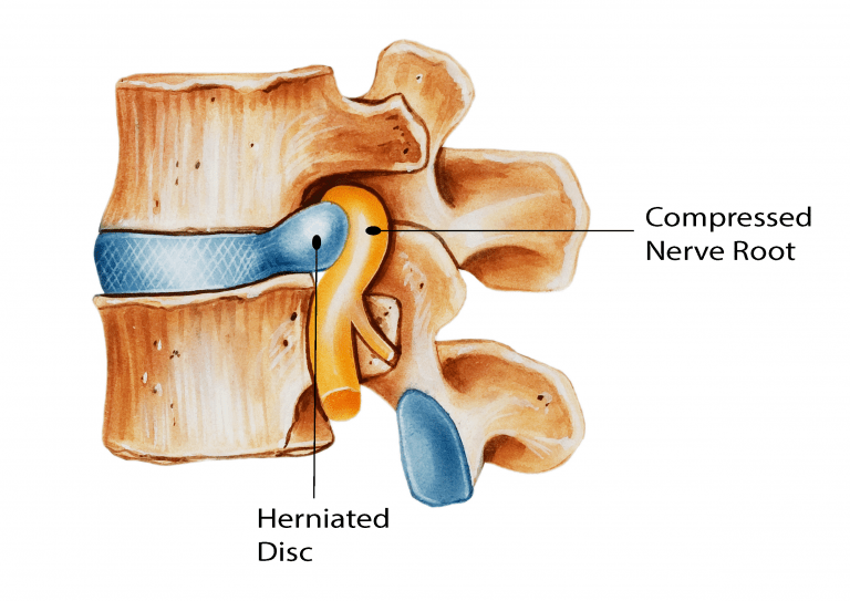 lumbar disc herniation, slipped disc