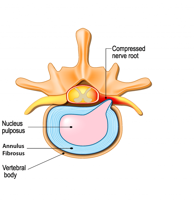 lumbar disc herniation, slipped disc, bulging disc, pinched nerve