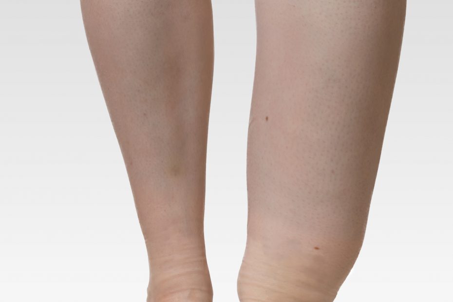 swollen leg, varicose veins class III