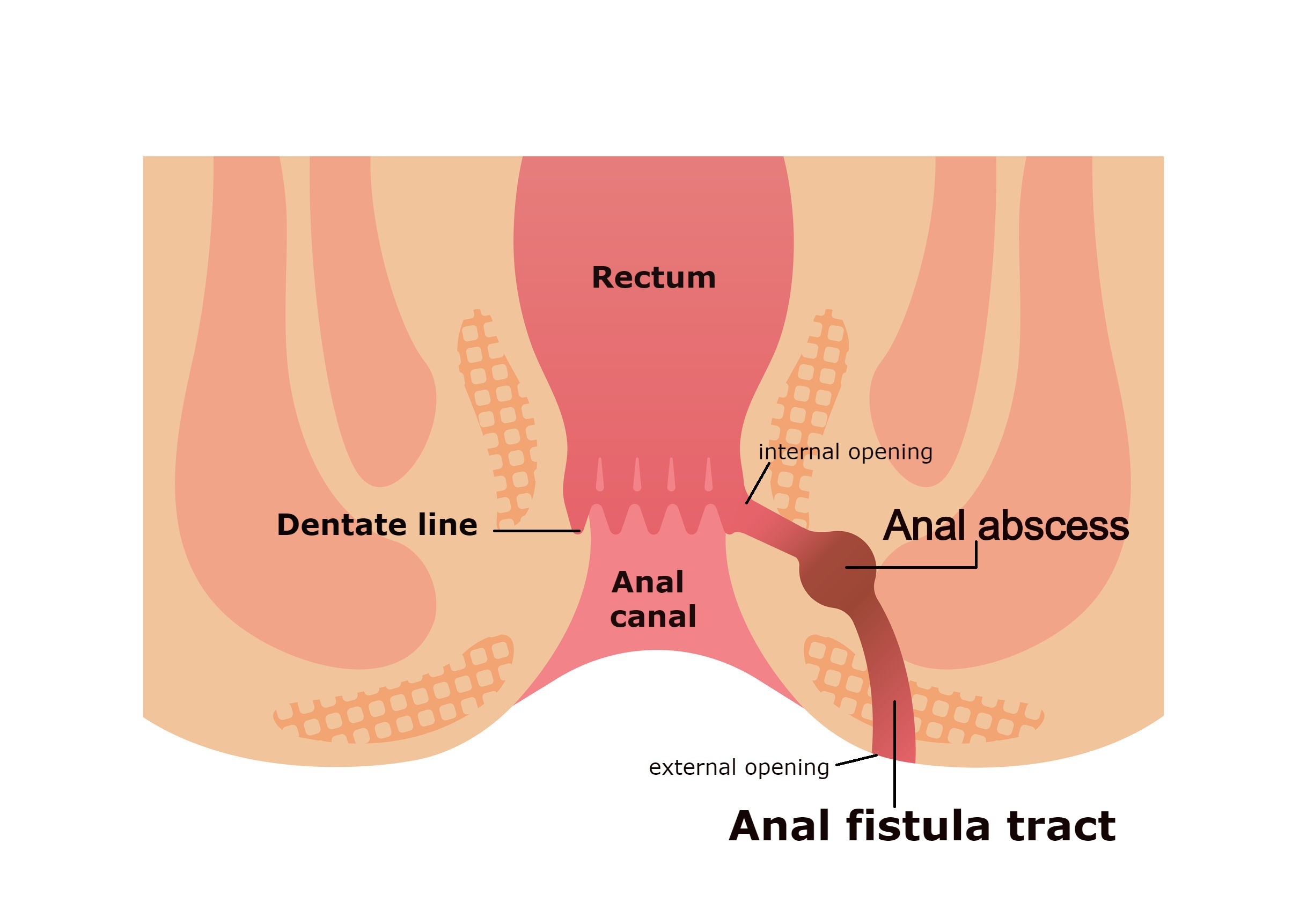 What is Anal Fistula? | Anal Fistula Treatment - WSM Medic