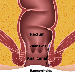 haemorrhoids pandemic period