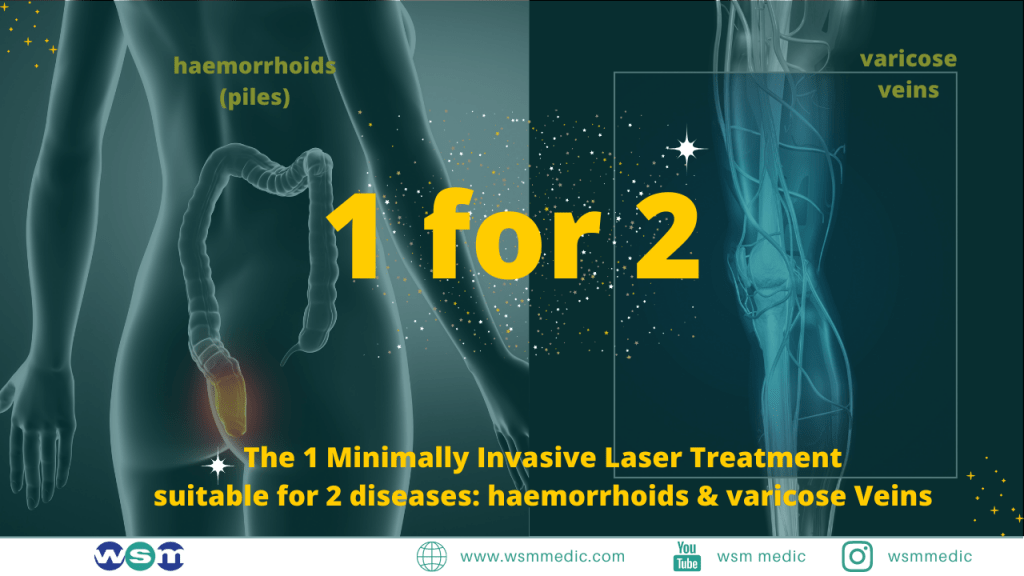 Malaysia Laser Haemorrhoids Treatment Laser Varicose Veins