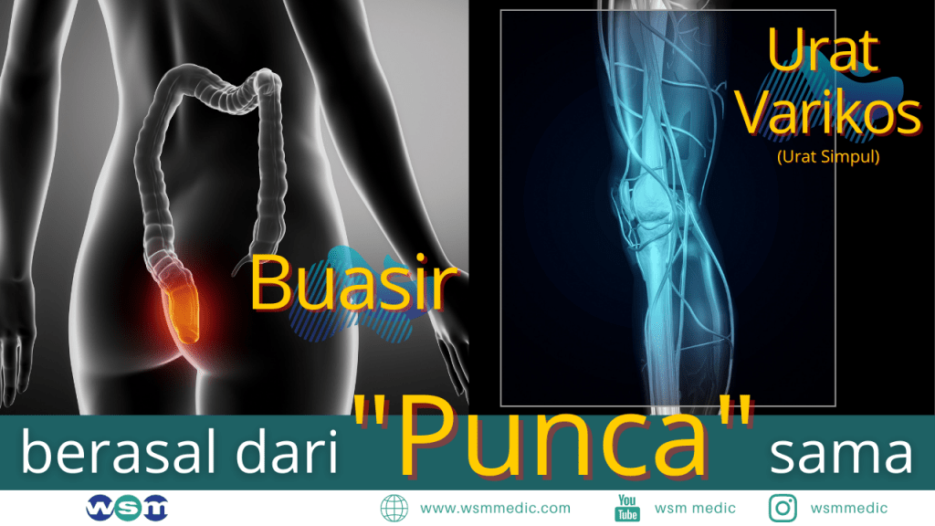 rawatan laser untuk buasir dan urat simpul