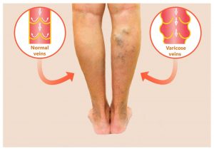 insurance cover varicose veins 