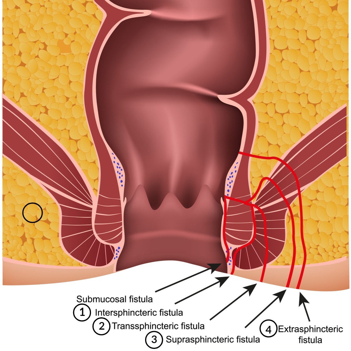 Anorectal Fistula Classification