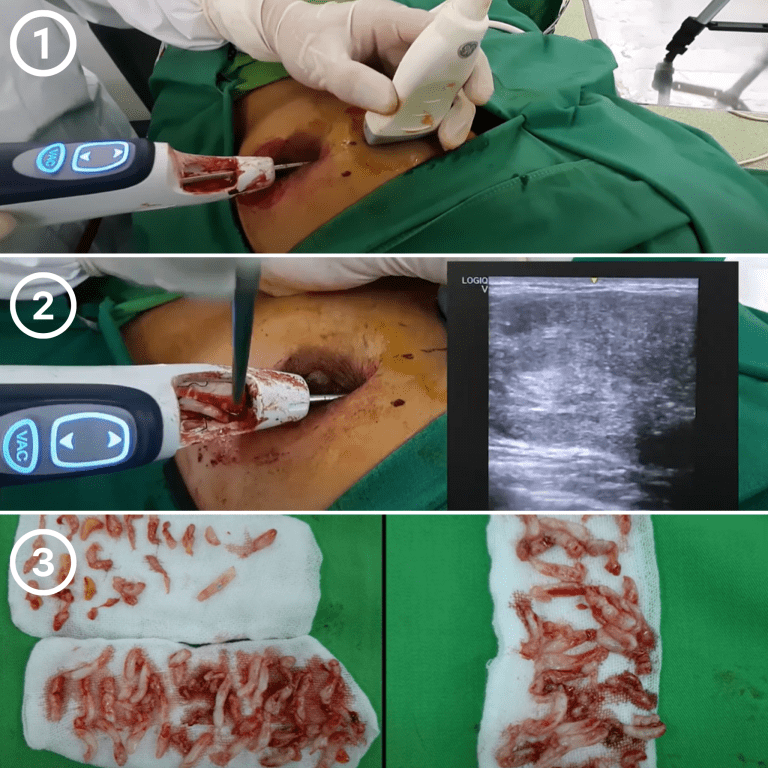 Microwave Ablation Breast Lump Treatment