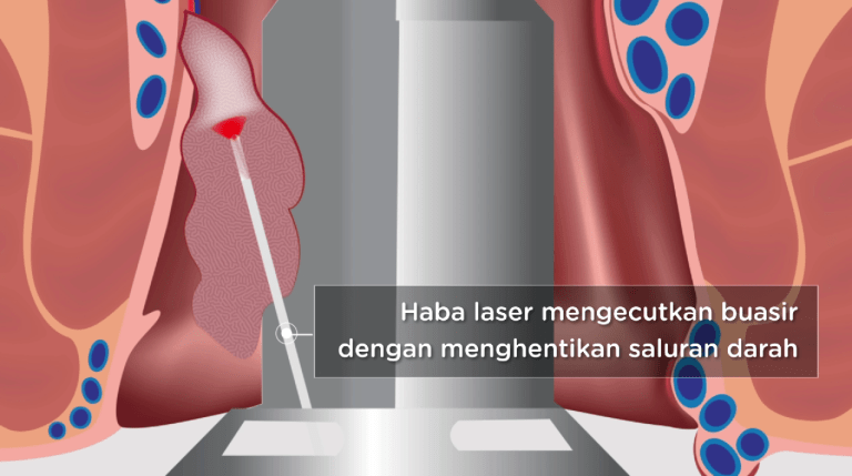 Malaysia Laser Buasir Treatment