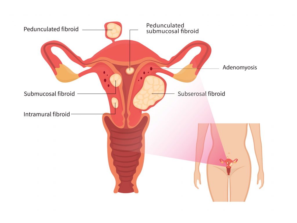 Microwave Ablation Fibroids Adenomyosis Treatment Malaysia