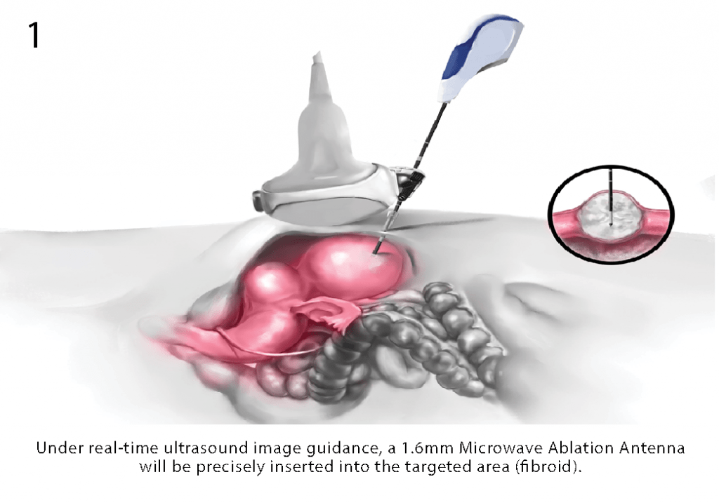 Microwave Ablation Fibroid Treatment Malaysia