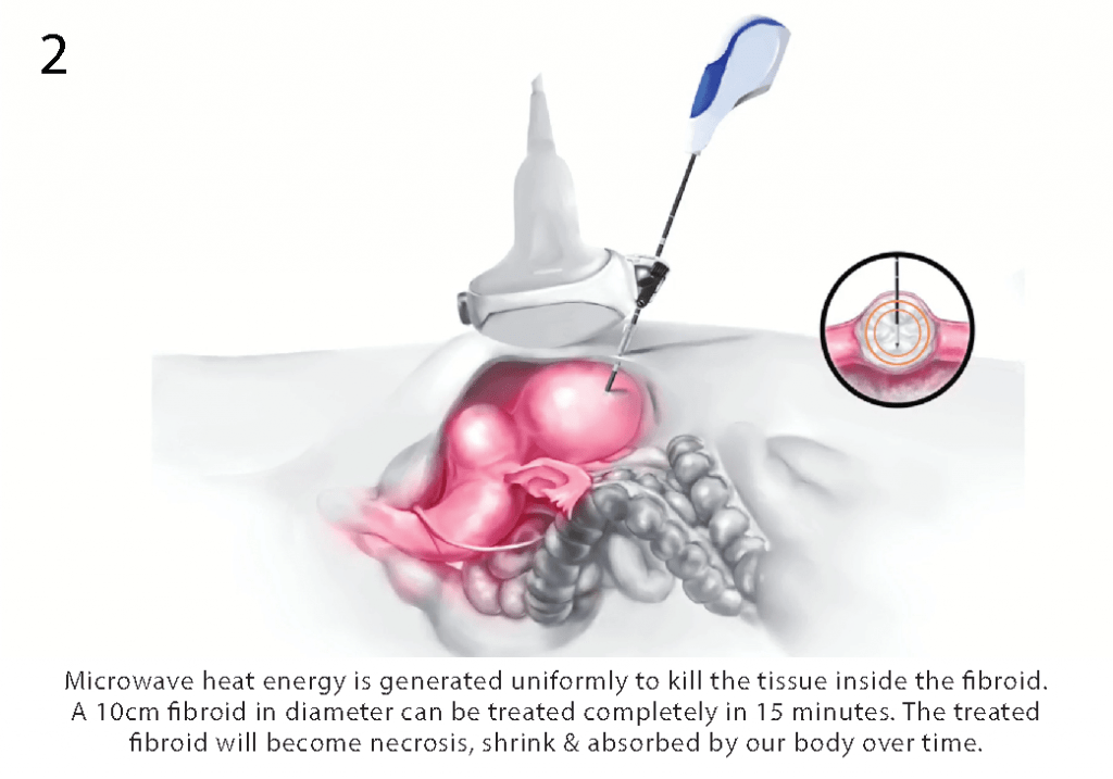 Microwave Ablation Fibroid Treatment Malaysia