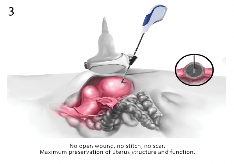 MWA Fibroid Procedure