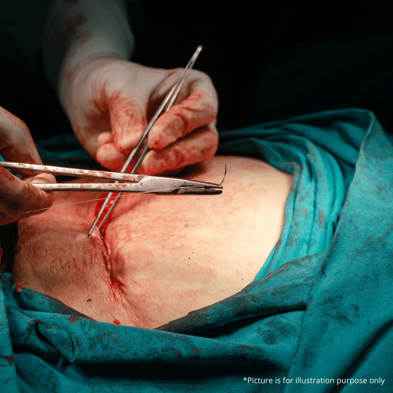 Surgical Procedure Fibroid