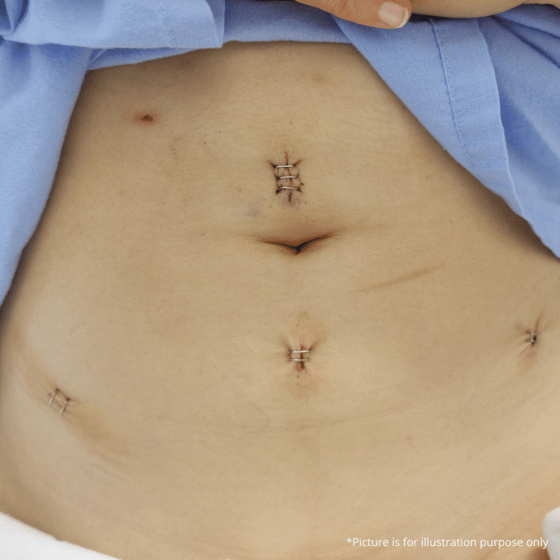 Surgical Procedure Fibroid (3)
