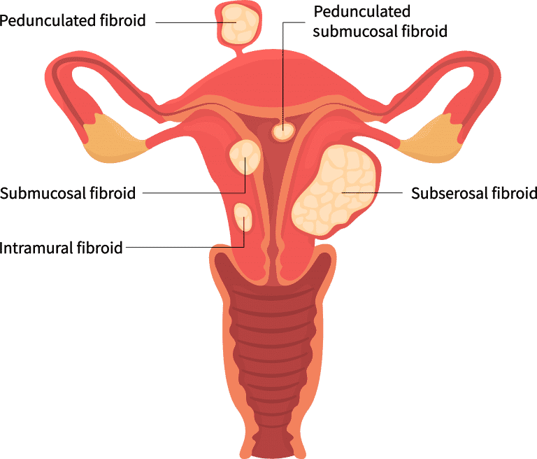 Microwave Ablation Fibroids Malaysia