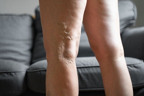 Laser Varicose Veins Malaysia