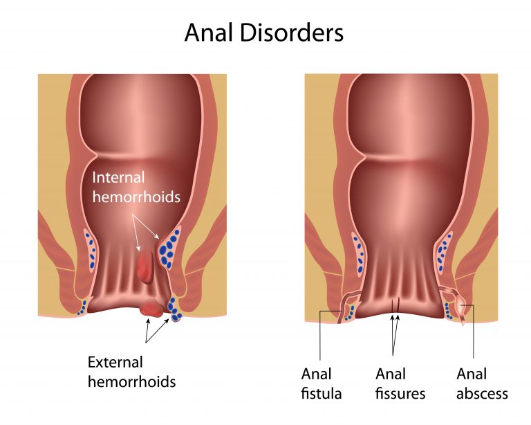 Difference between haemorrhoid, anal fistula and anal fissure