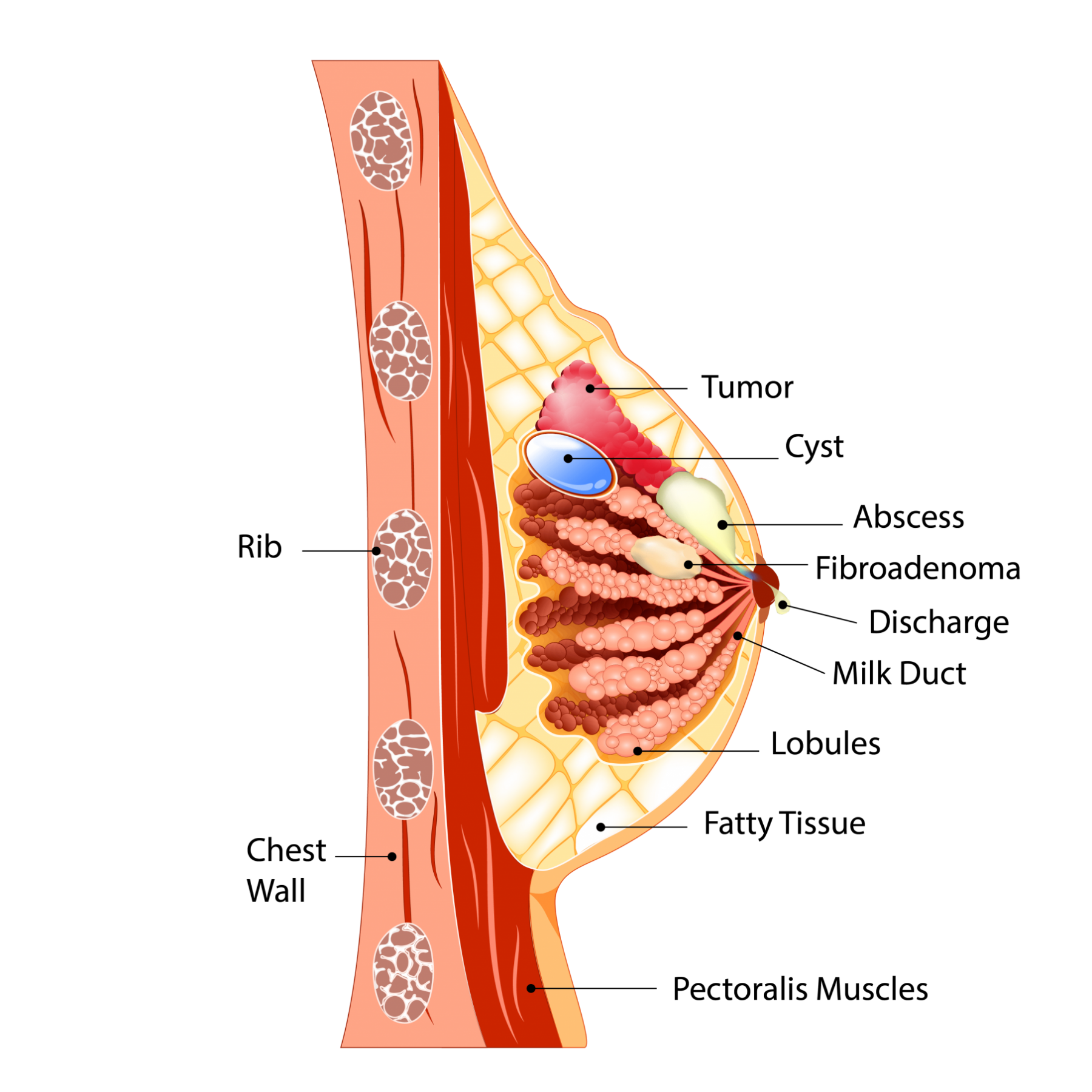 Microwave Ablation Breast Lump Treatment