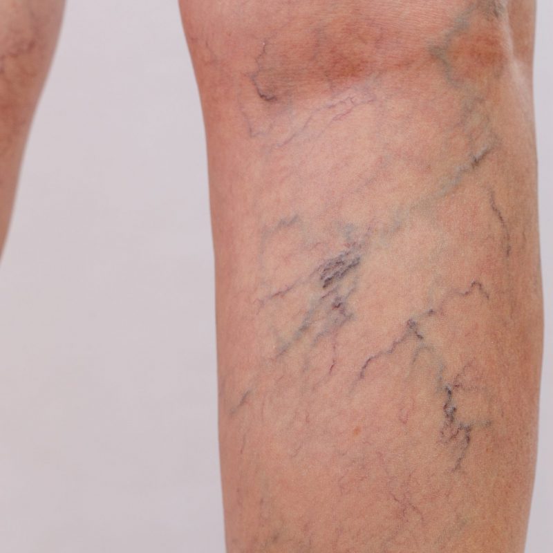 Spider Veins Treatment Malaysia