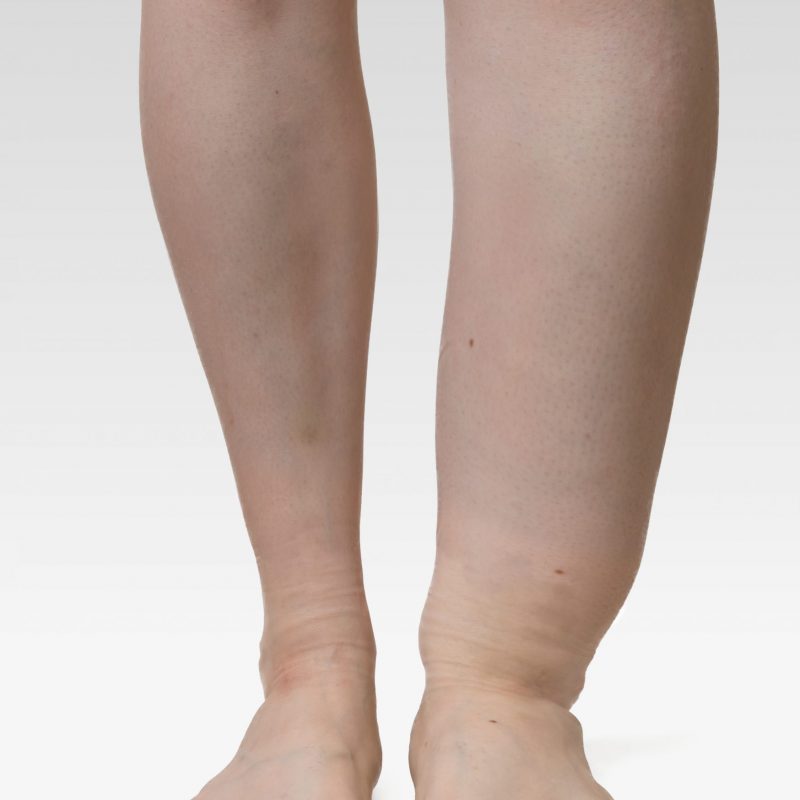 swollen leg, varicose veins class III