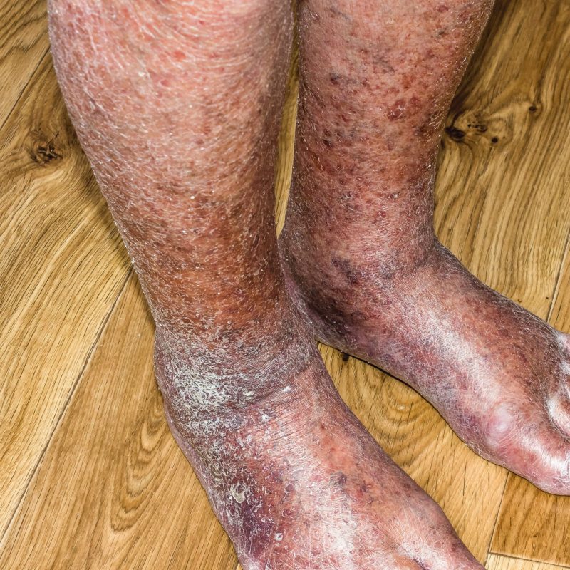 dry skin, varicose veins class 5