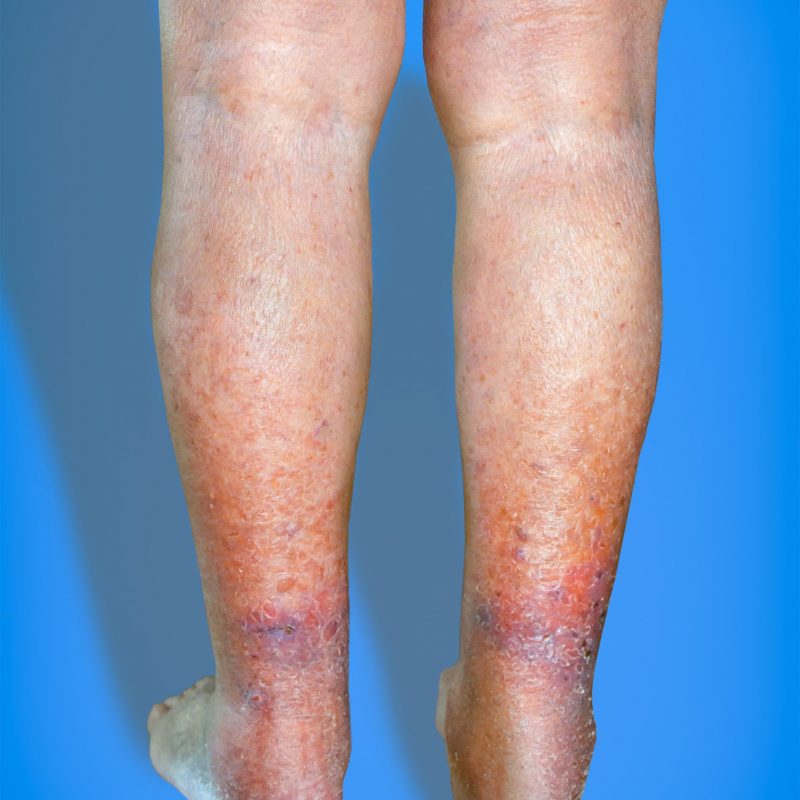 leg skin become darken, varicose veins class 5