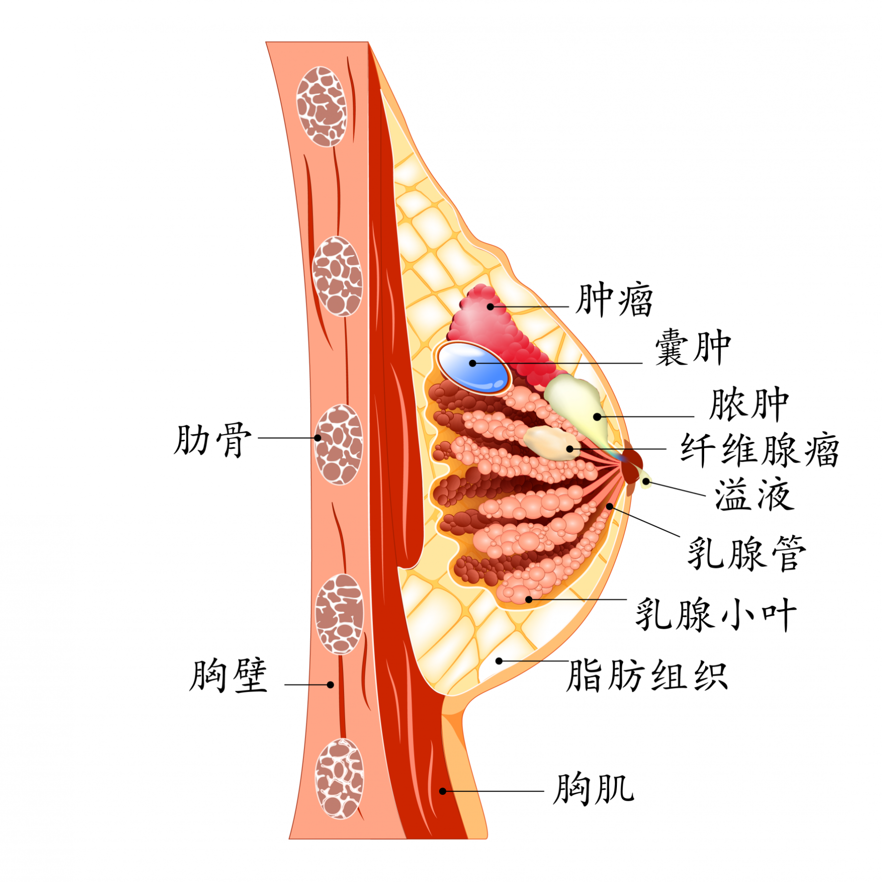 乳腺肿瘤